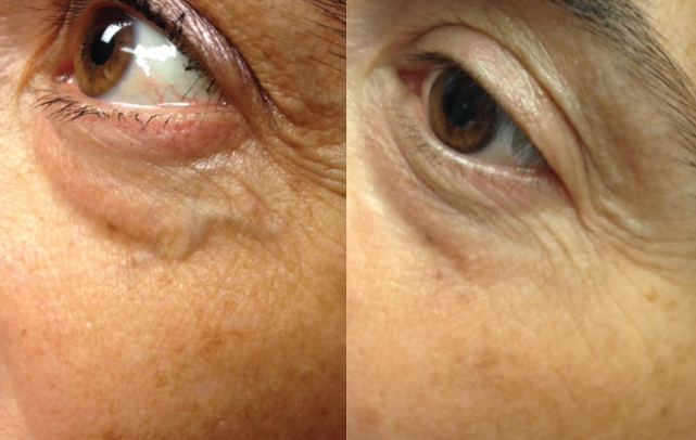 clearv-before-after